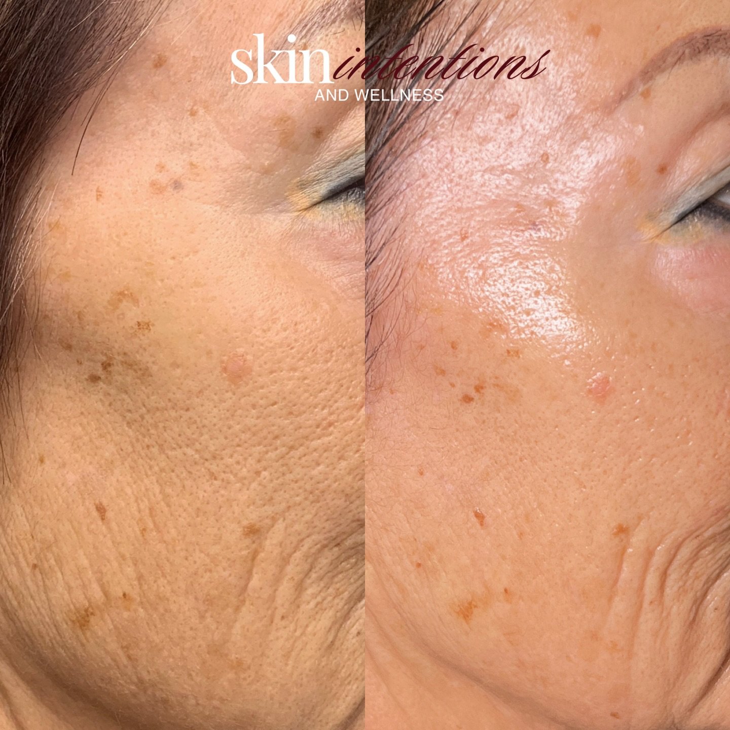 Before to After (client completed 5 sessions) of Procell Microchanneling Treatments

Let&rsquo;s talk real results and why clients are raving about this therapy

I mean look at these results&hellip;.INCREDIBLE!

Procell Therapies works by creating mi