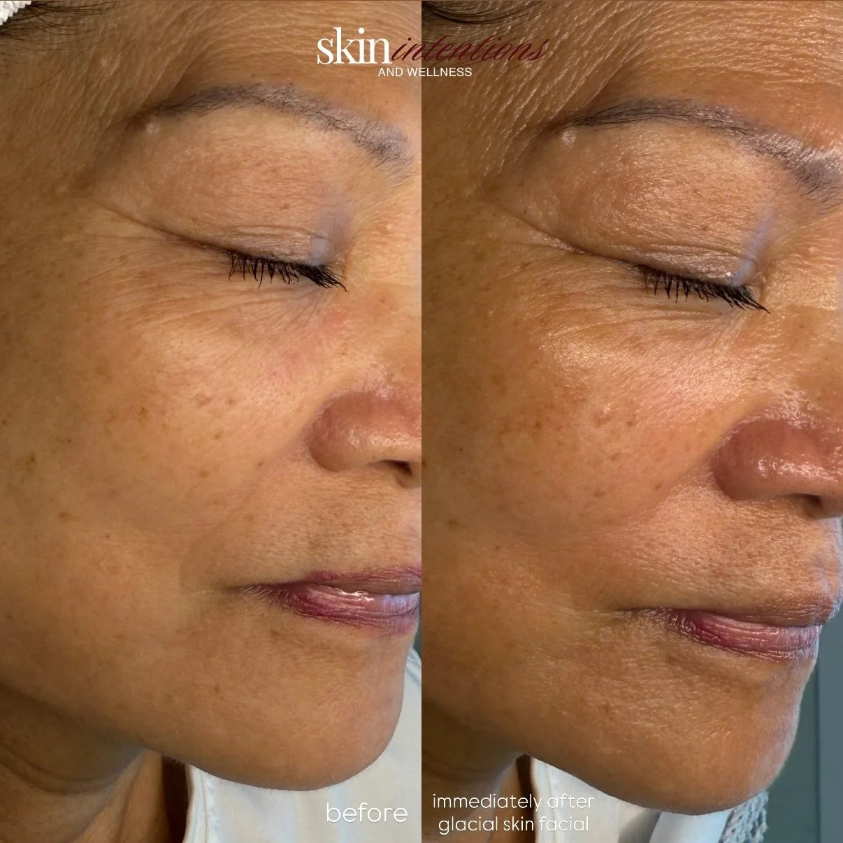 the results before and after a Glacial Skin Facial are telling you a story

a story of calmer skin, boosted hydration, reduced redness, and youthful appearance that starts beneath the surface. While every skin journey is unique, seeing the transforma