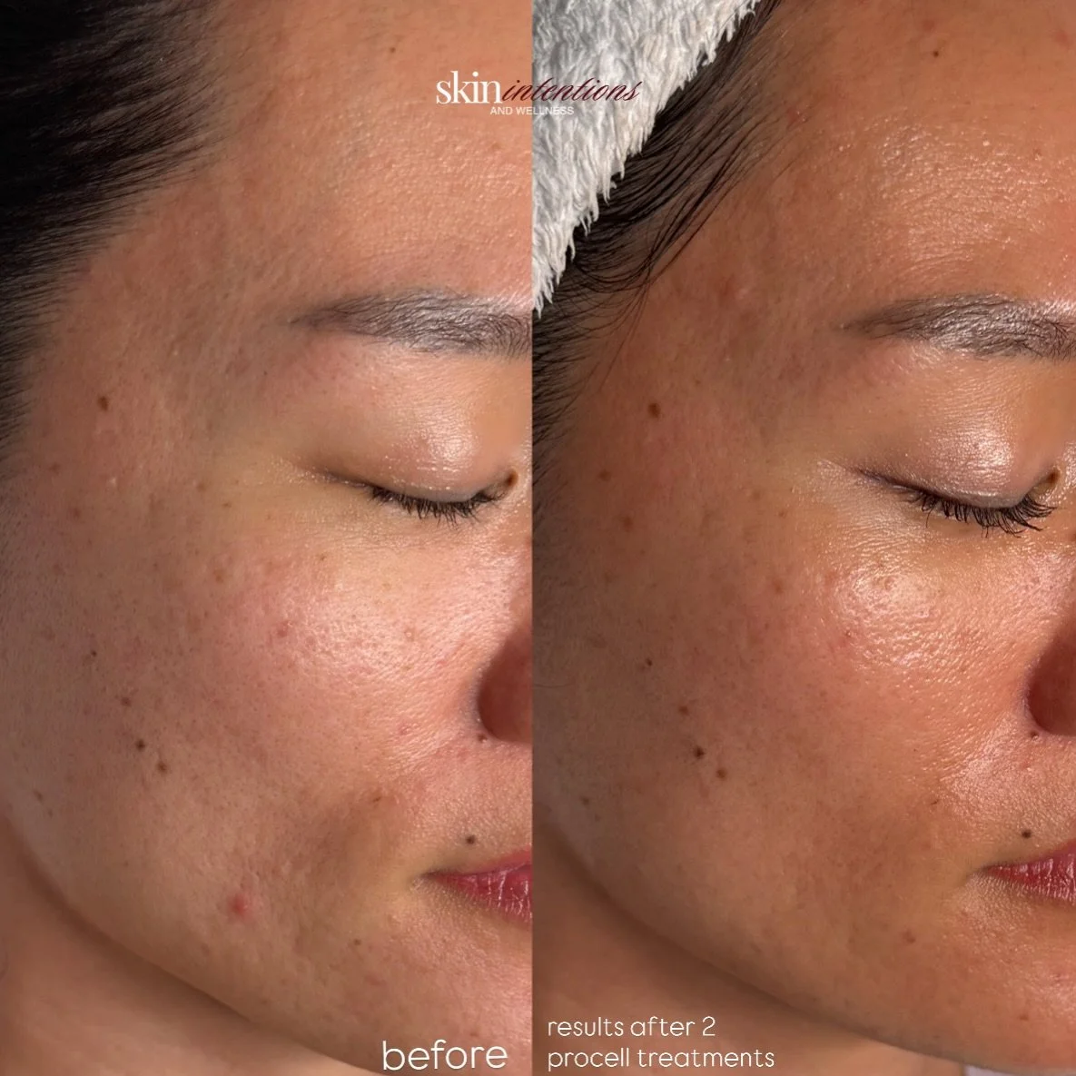 transformation that started with a consultation

when my client first came to me, she was struggling with active acne, post-acne marks, and older acne scarring.

we began with a thorough consultation to understand her skin, lifestyle, and goals. From