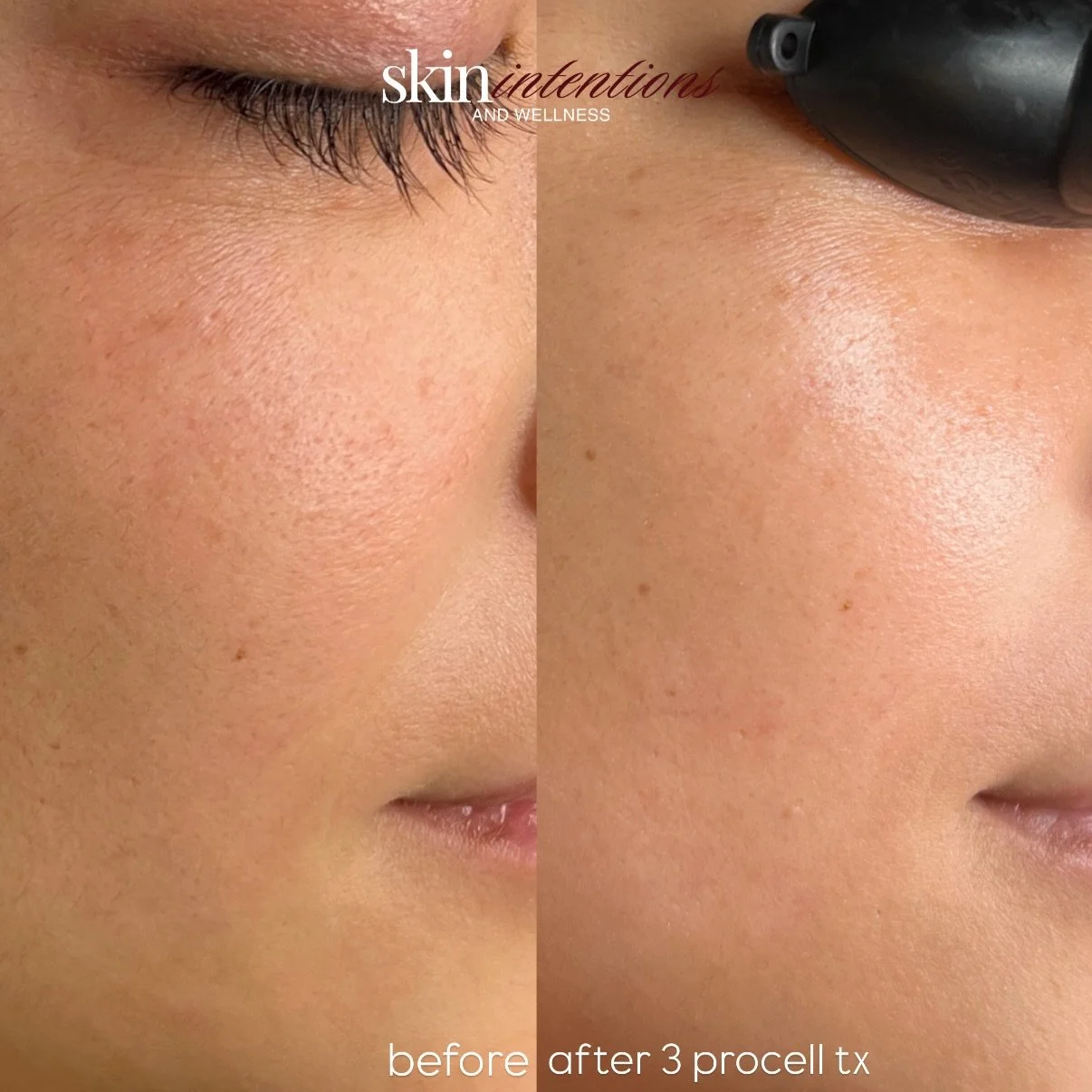What makes Procell different?

These results are after a Procell Microchanneling treatment, designed to stimulate your body&rsquo;s natural healing response and support long-term skin health. 

Unlike treatments that only work on the surface, Procell