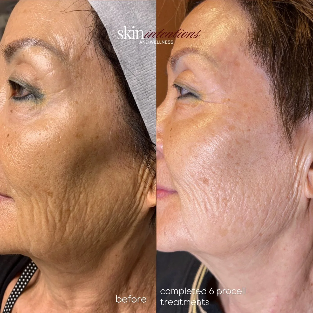 One of my favorite skin transformations 🪞✨

Her goal was simple: healthier, firmer, more youthful-looking skin.

We started by simplifying her approach, creating a personalized treatment plan, and focusing on consistency and sticking to a skincare r