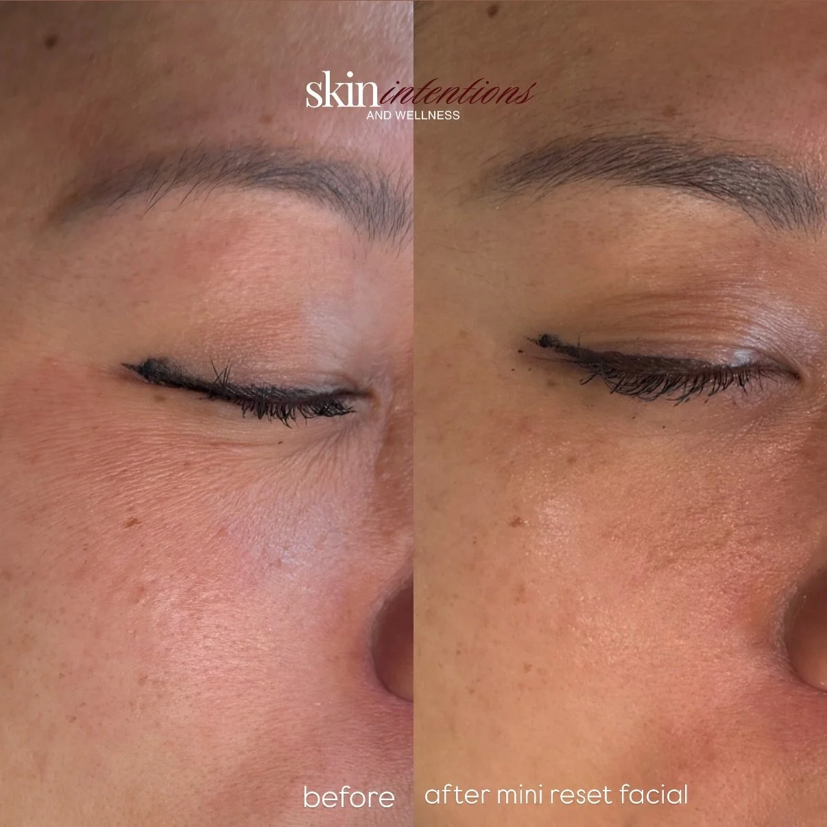 Professional treatments can help accelerate results and address the root cause of these concerns. 

As an aesthetician, I often find that clients are using multiple products but still struggling with dehydration, sensitivity, or barrier impairment. 
