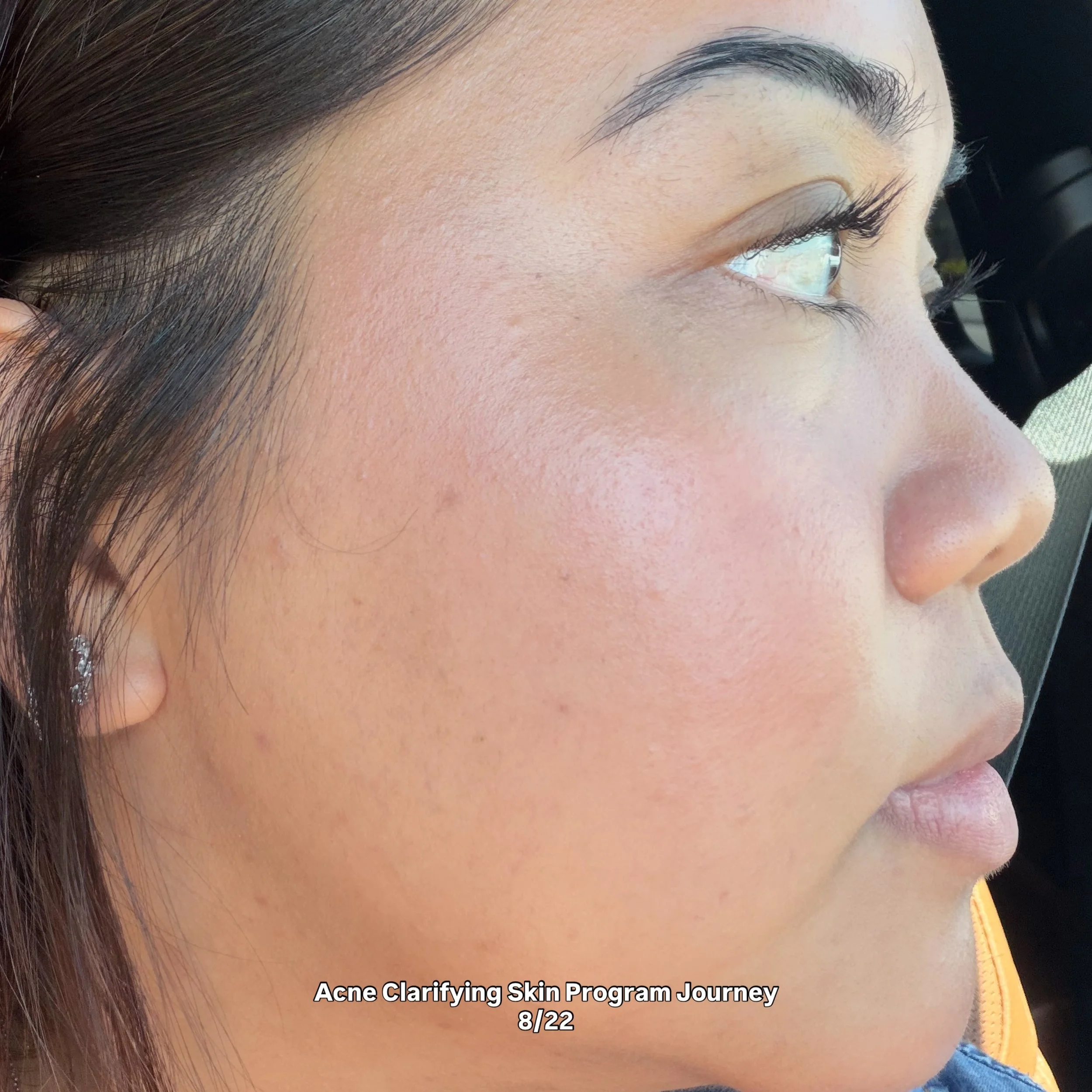 Oh, what a journey it&rsquo;s been. 🤍🗺️

I created my Acne Clarifying Skin Program from a very personal place. I&rsquo;ve struggled with acne myself, and through my own journey and through continuing my education I&rsquo;ve learned that clearing ac