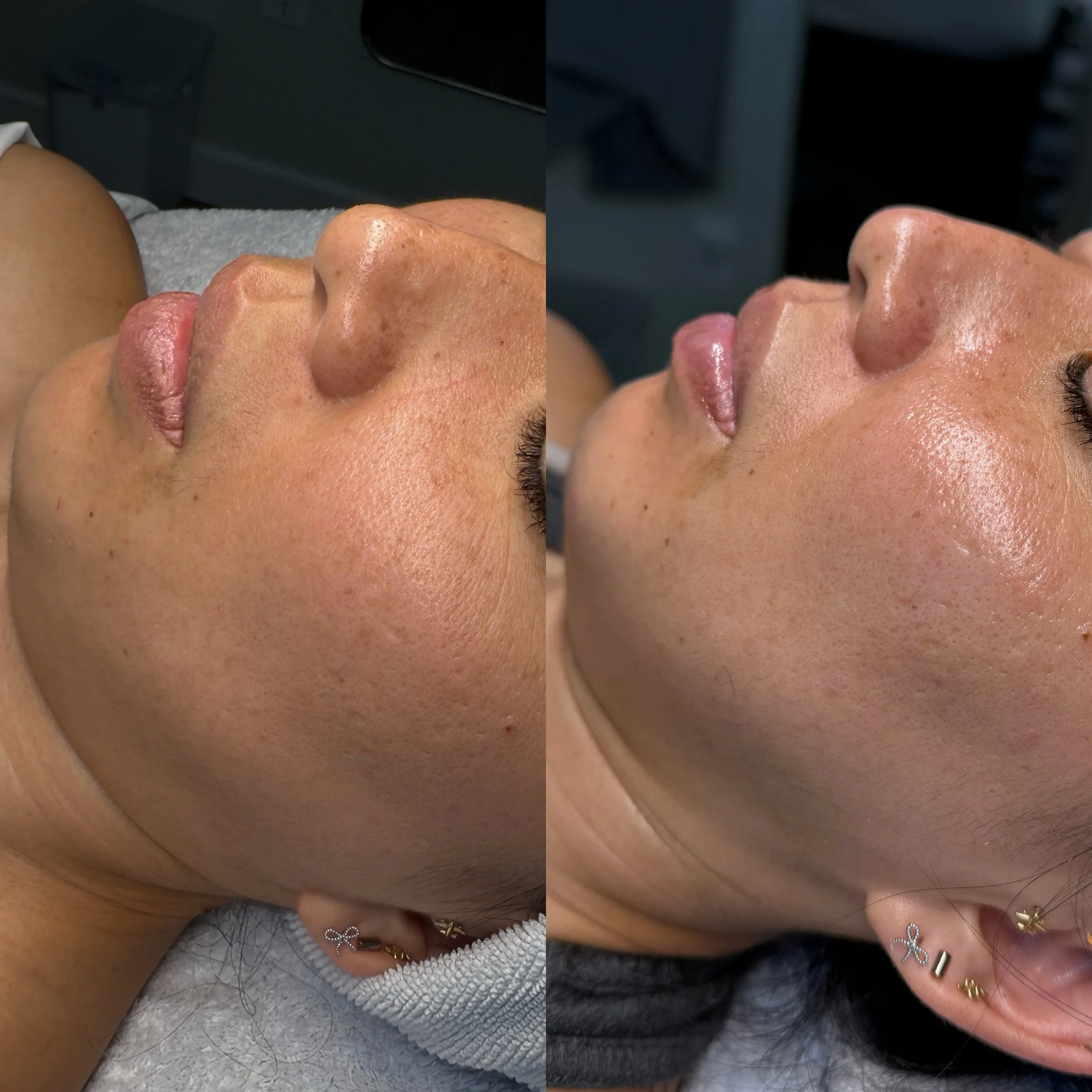 glacial skin facial in kaimuki