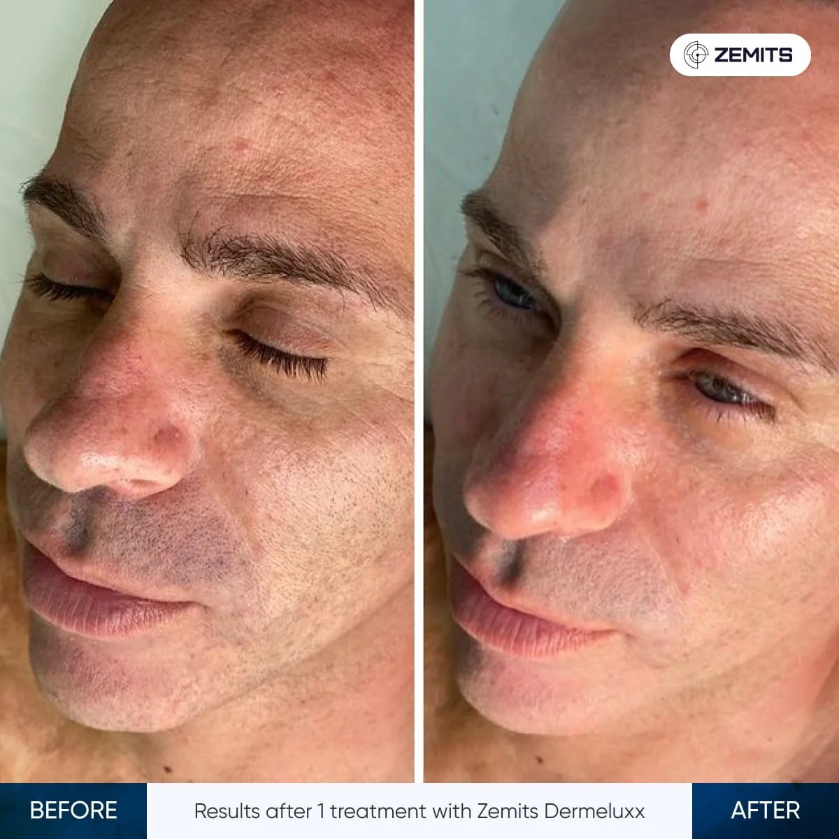 A side-by-side comparison photo showing the face of a man with improved skin texture, clarity, and reduced redness after treatment, labeled 'Before' and 'After.' The 'After' side shows a smoother complexion with less visible redness and blemishes.
