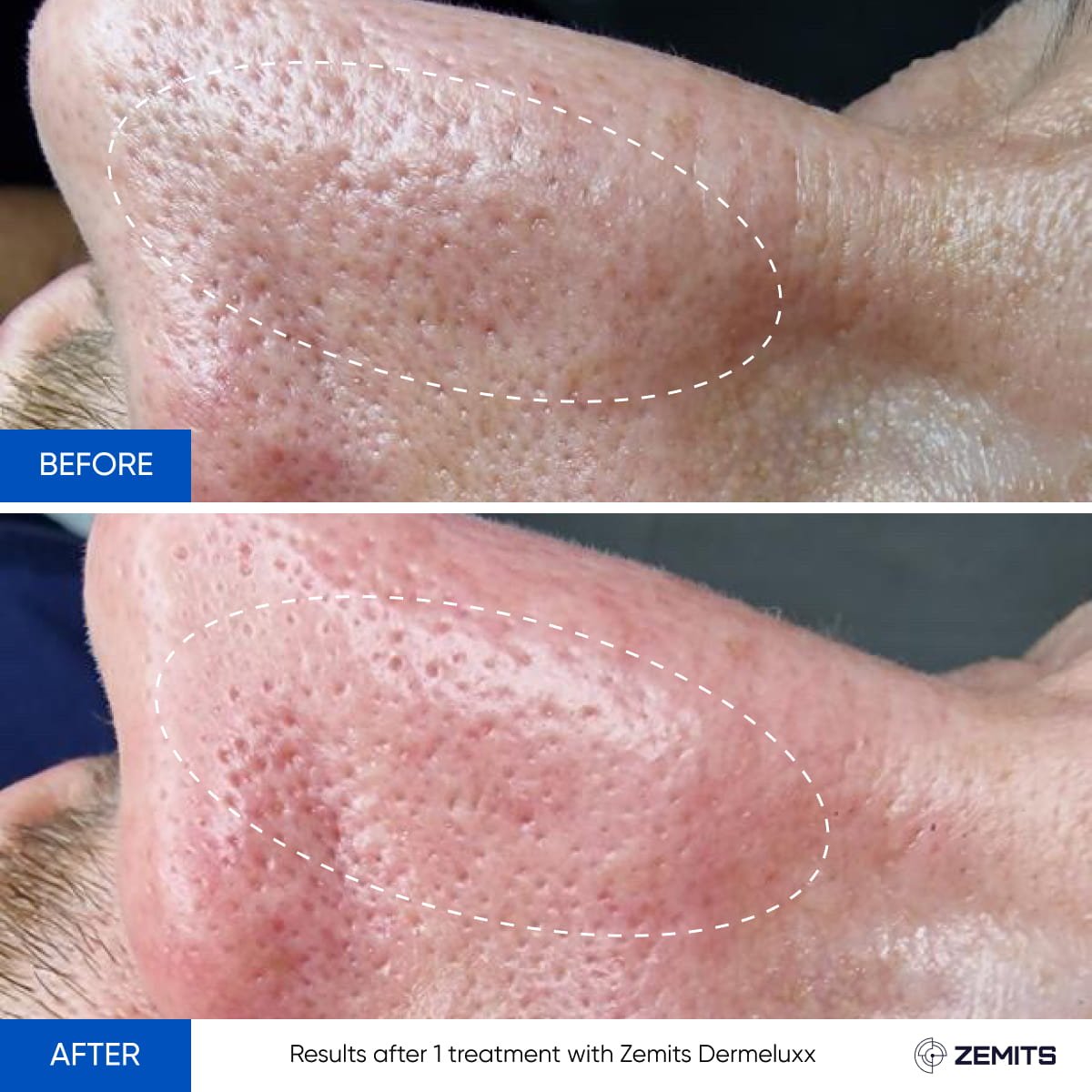 Close-up of a person's nose showing skin improvements before and after a treatment with Zemits Dermaluxx. The 'before' image shows clogged pores and redness, while the 'after' image shows clearer, less congested skin.