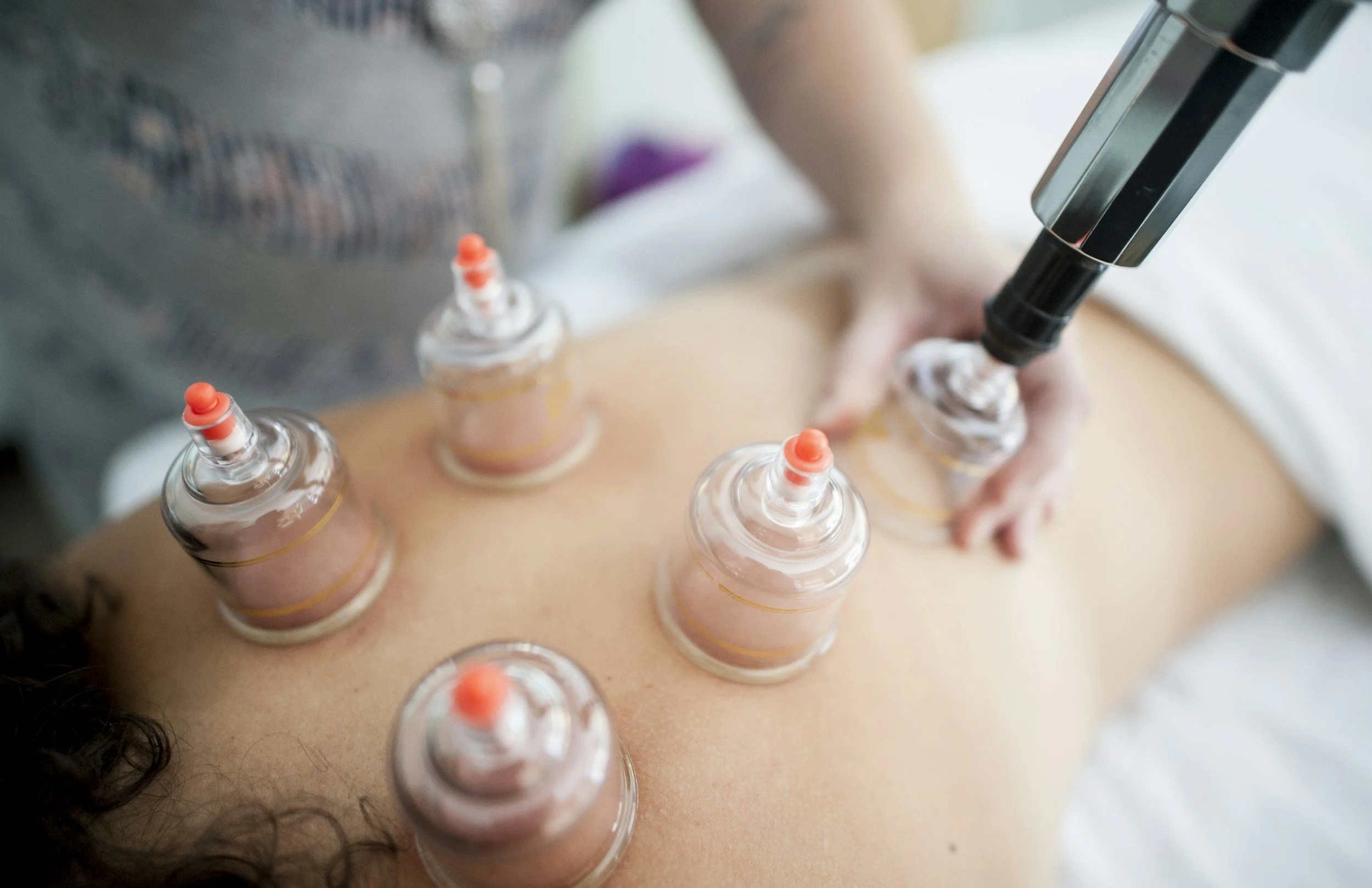 A person receiving cupping therapy with multiple glass cups on their back, and a practitioner using a suction device on one of the cups.