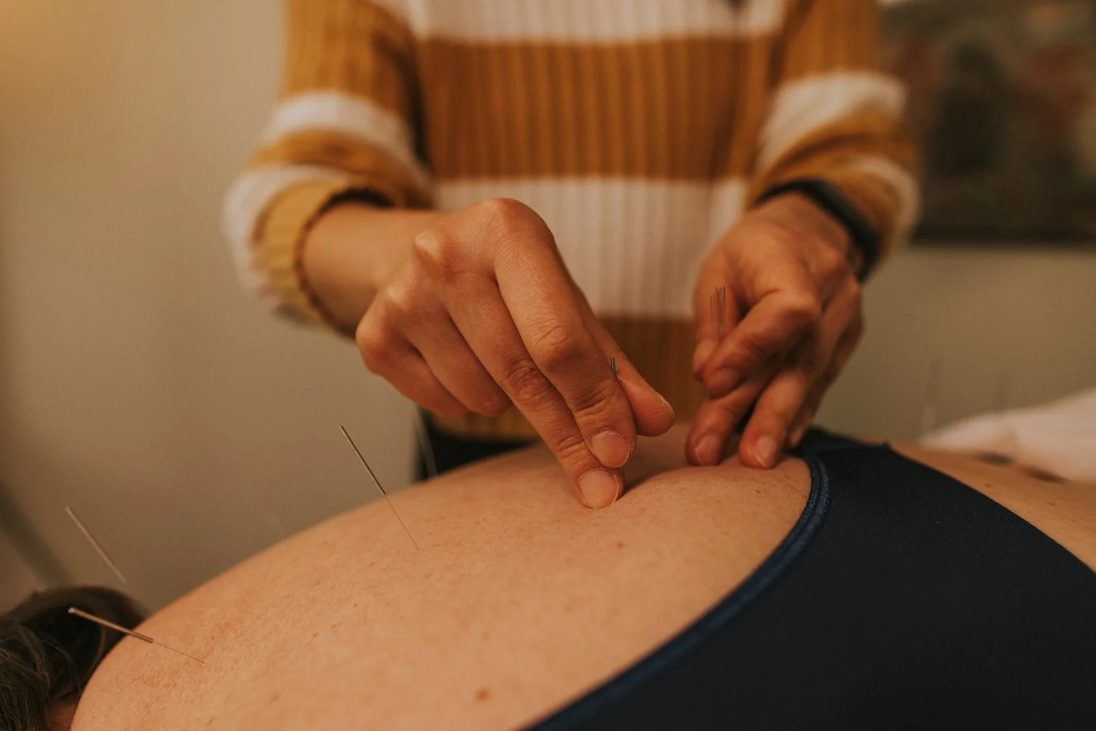 Person receiving acupuncture treatment with thin needles inserted into their back, while an acupuncturist gently manipulates one of the needles.