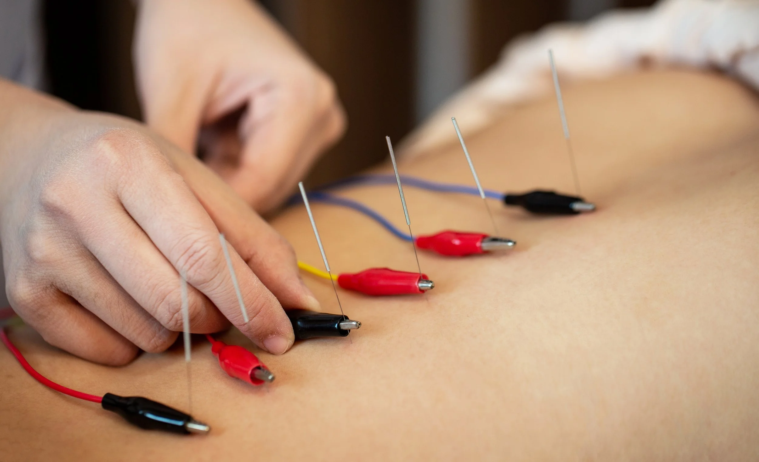 A person receiving an acupuncture treatment with thin needles inserted into their bare back, connected to wires with alligator clips.