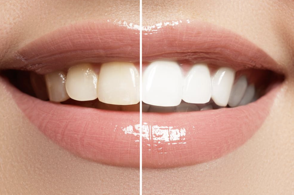 How to Have the Perfect Smile