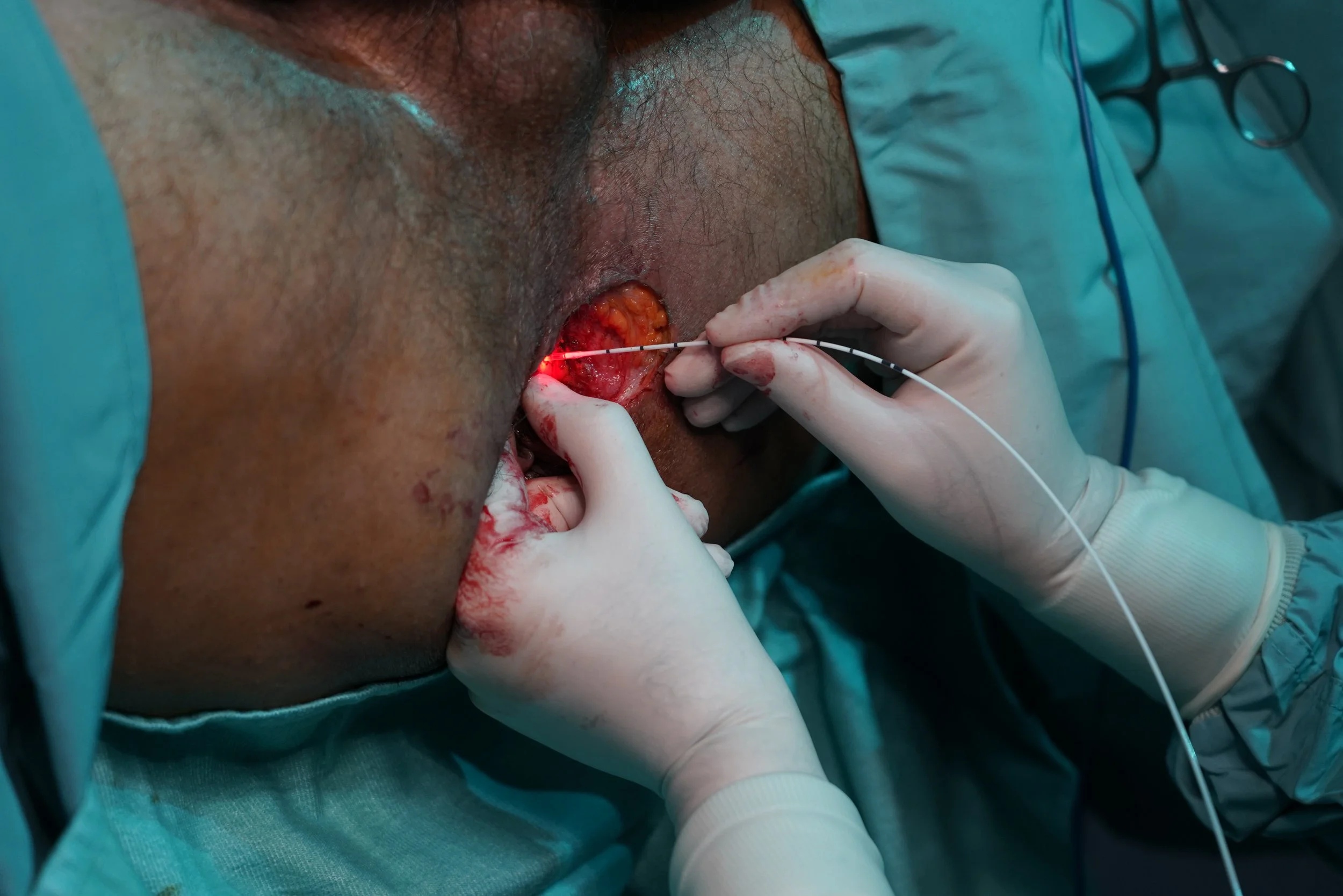 Un chirurgo sta eseguendo un intervento medico sul'apparecchiatura chirurgica, usando guanti di lattice, con un'illuminazione laser rossa.