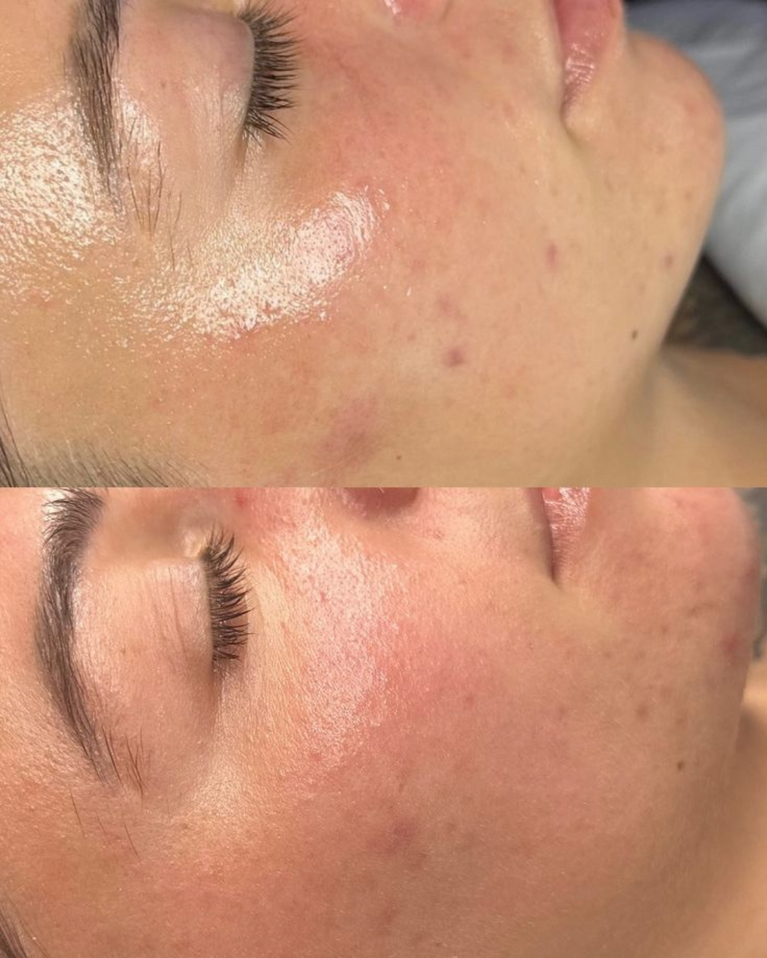Copie de HYDRAFACIAL BEFORE AFTER IG POST.PNG