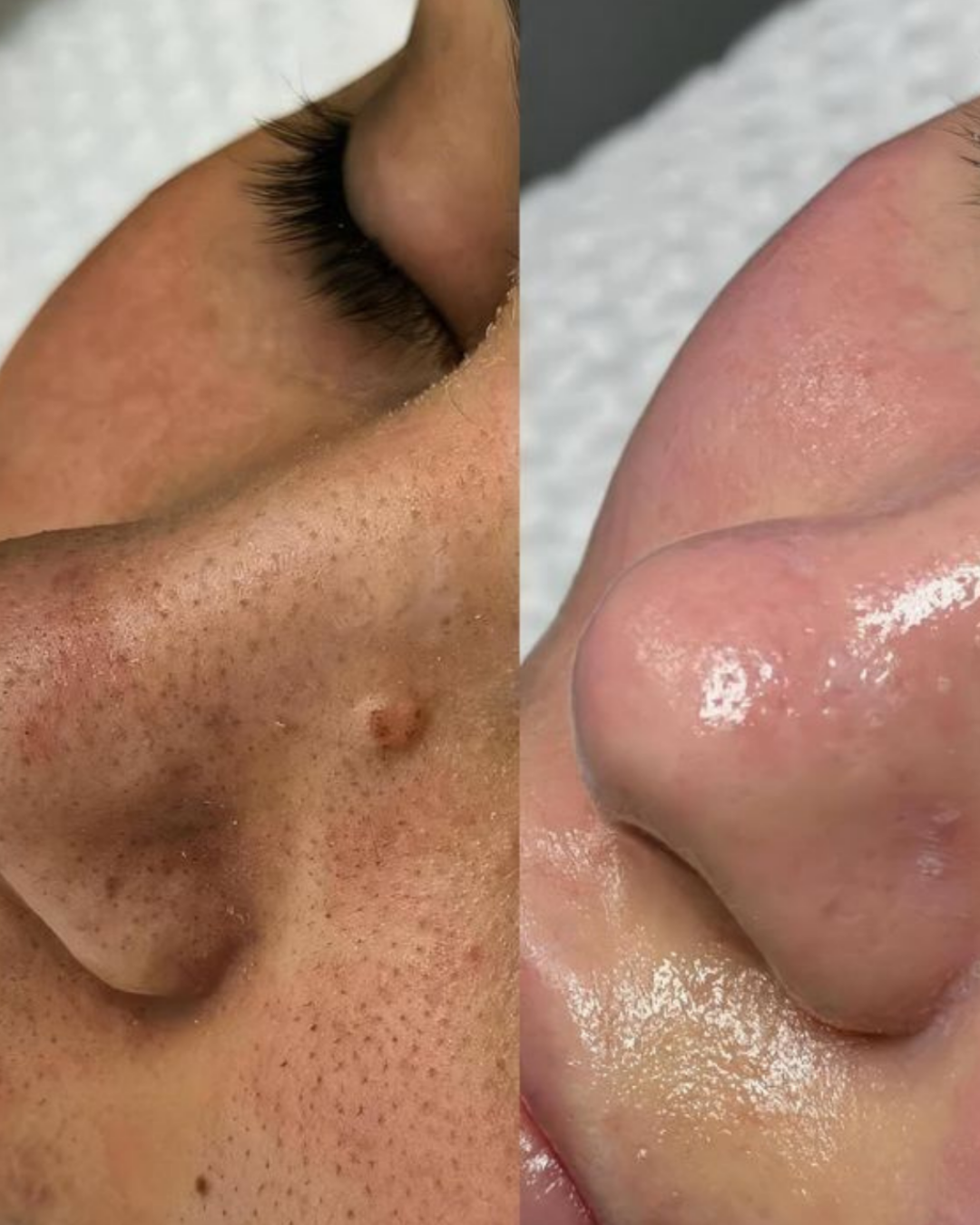 Copie de HYDRAFACIAL BEFORE AFTER IG POST.png.PNG