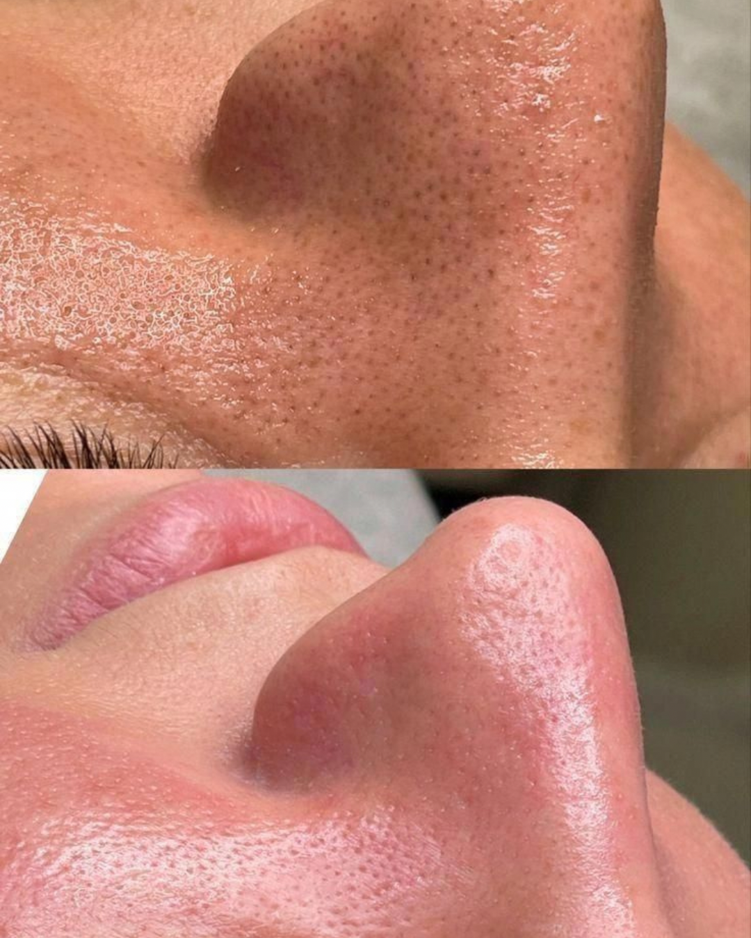 Copie de HYDRAFACIAL BEFORE AFTER IG POST 2.PNG