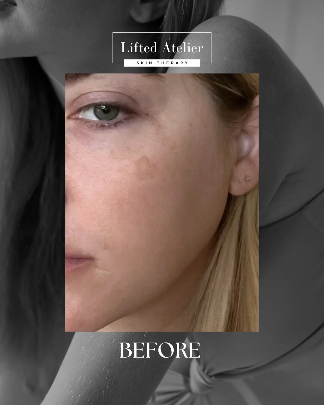 Swipe to see how microneedling lightened a dark spot within a week 👉🏼

Microneedling creates controlled micro-injuries in the skin to stimulate collagen + elastin production. Over time, that boost in cell renewal helps improve:
&bull; Dark spots an