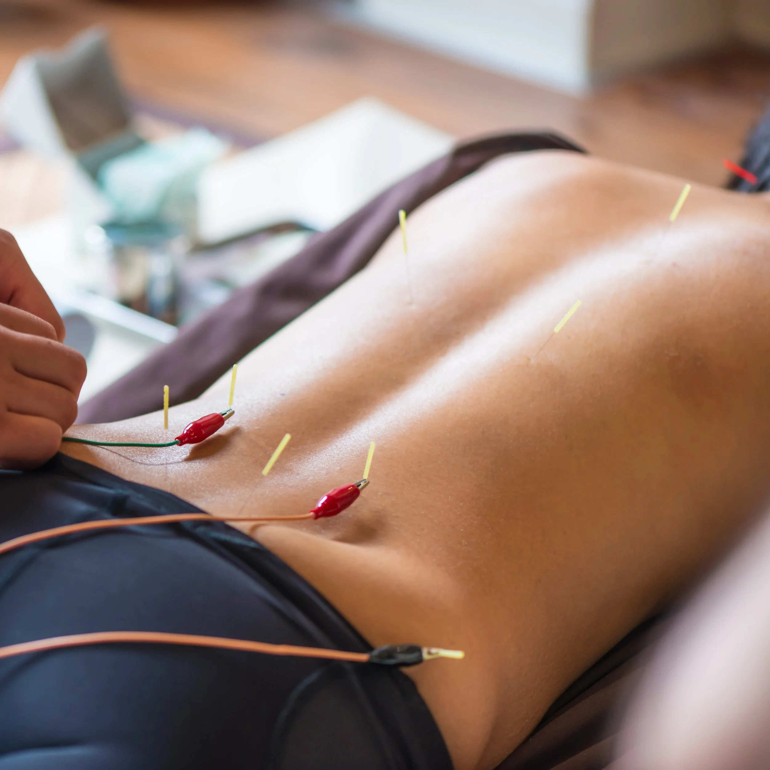 What Is Electroacupuncture? E-Stim for Fertility, Reproductive Health &amp; Labor Support