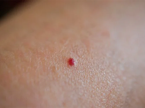 Close-up of human skin with a small, red pimple.
