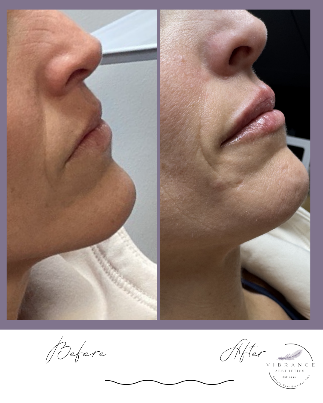 A woman is receiving a cosmetic facial treatment, with a gloved hand holding a syringe near her face.