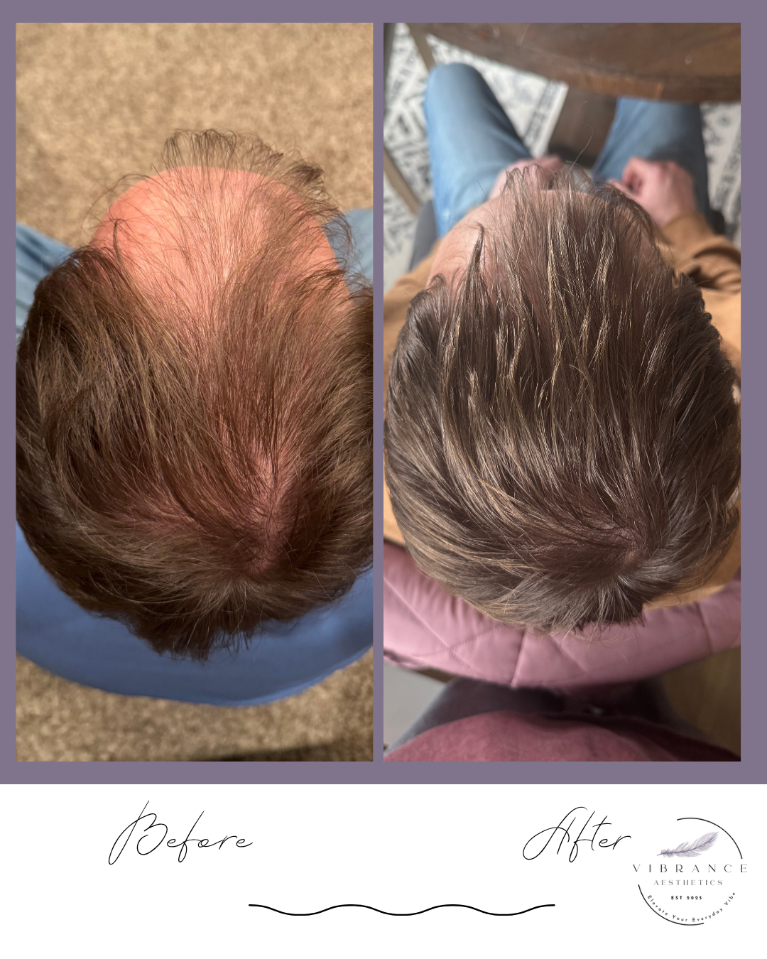 A person wearing blue gloves administering an injection of PRP into a man's scalp.