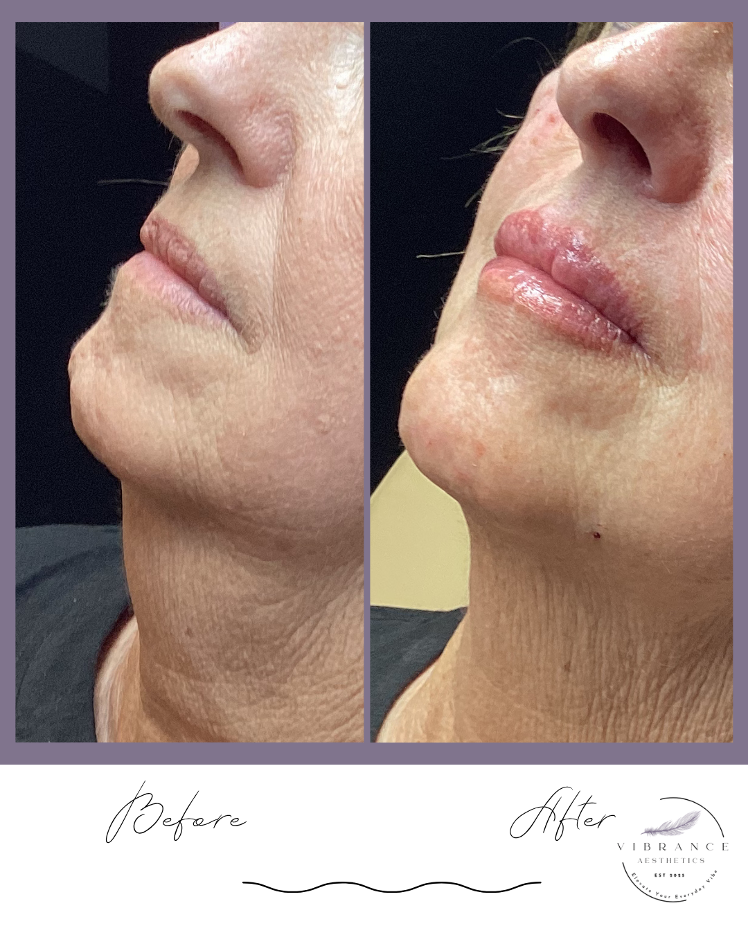 A person is receiving a cosmetic injection, possibly Botox or dermal filler, administered by a medical professional wearing black gloves.