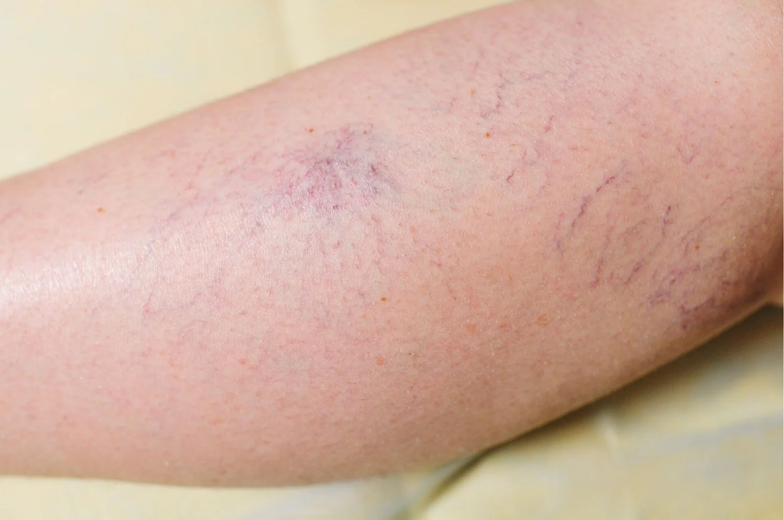 Close-up of a person's forearm showing visible varicose veins.