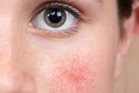 Close-up of a person's face showing a blue eye and redness on the cheek.