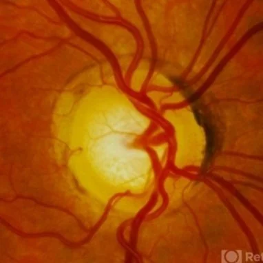 Close-up of the human eye's retina showing the optic disc and blood vessels.