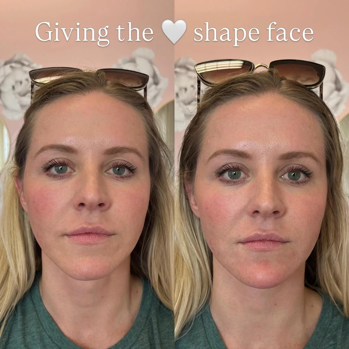 Facial balancing this beauty with strategic placement of chin filler creating the most beautiful heart shape face 💉💉💉
