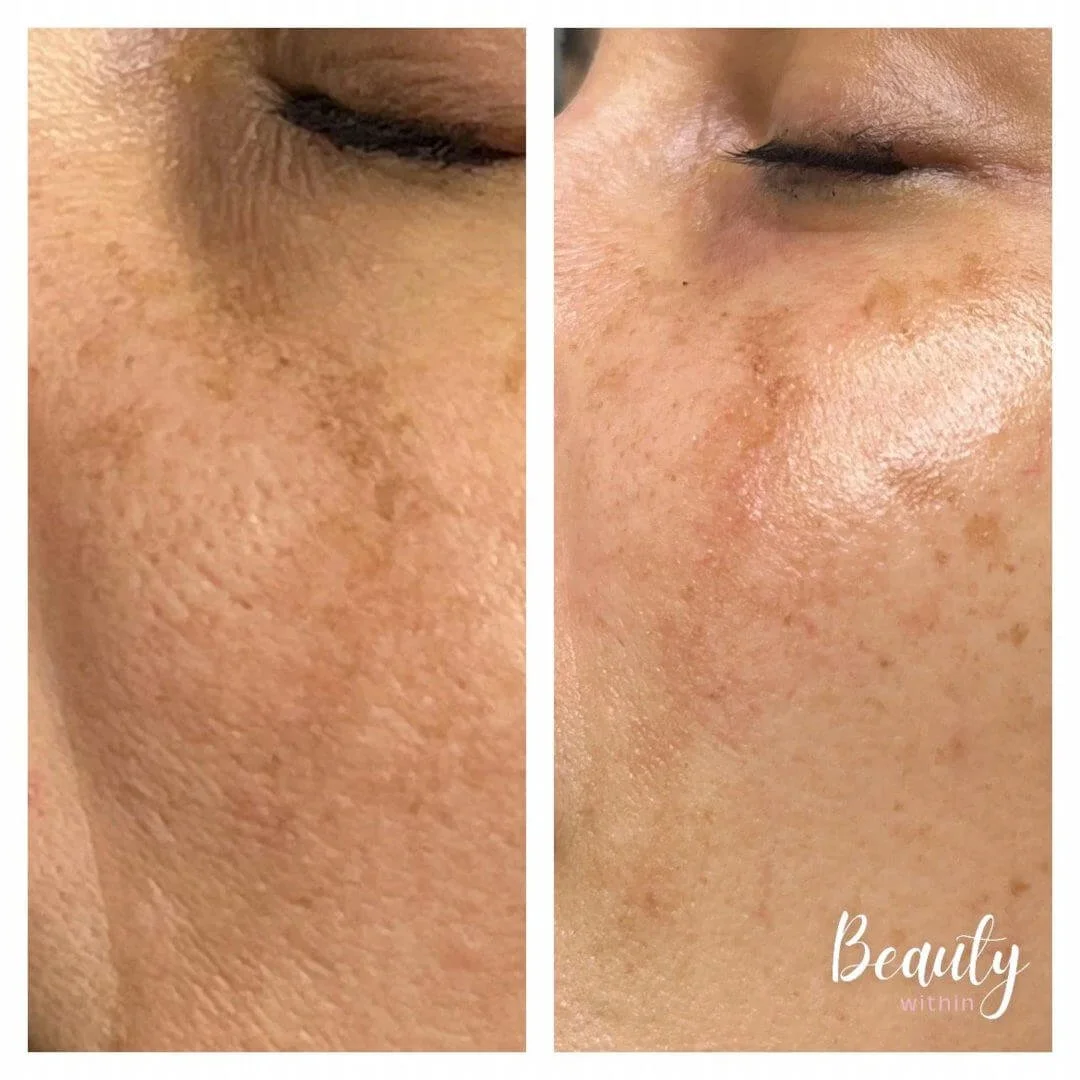 Before and after results showing improved skin tone and reduced pigmentation following PRX Plus brightening therapy.