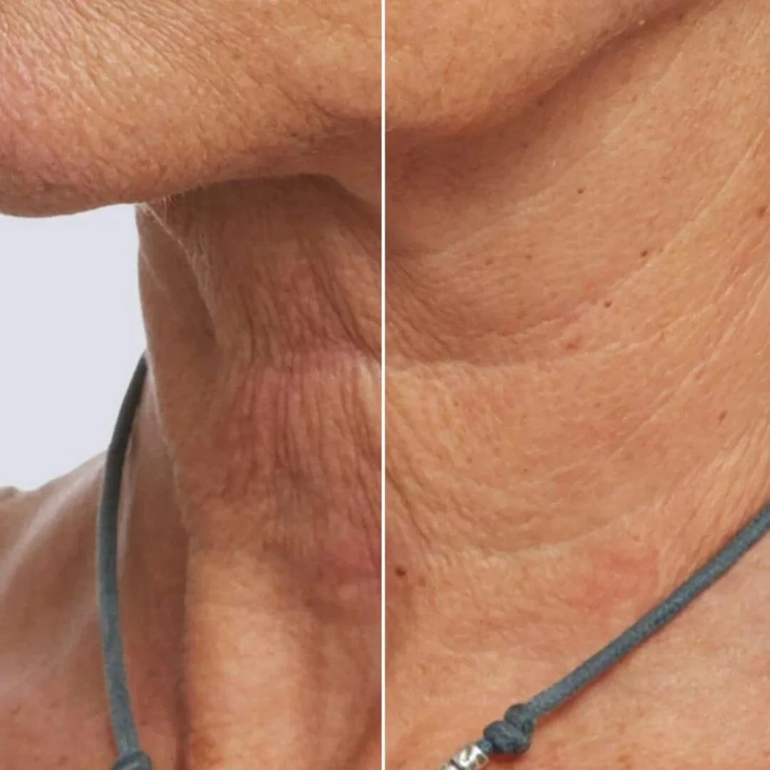 Before and after comparison showing visible neck rejuvenation and improved skin texture after PRX Plus therapy.