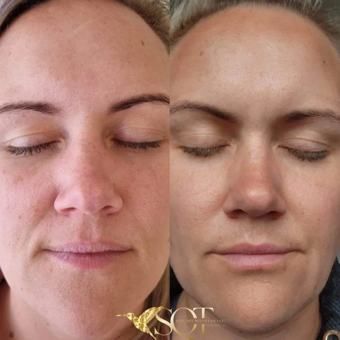 Before and after client images demonstrating the appearance of refreshed and naturally renewed skin after SQT treatment.