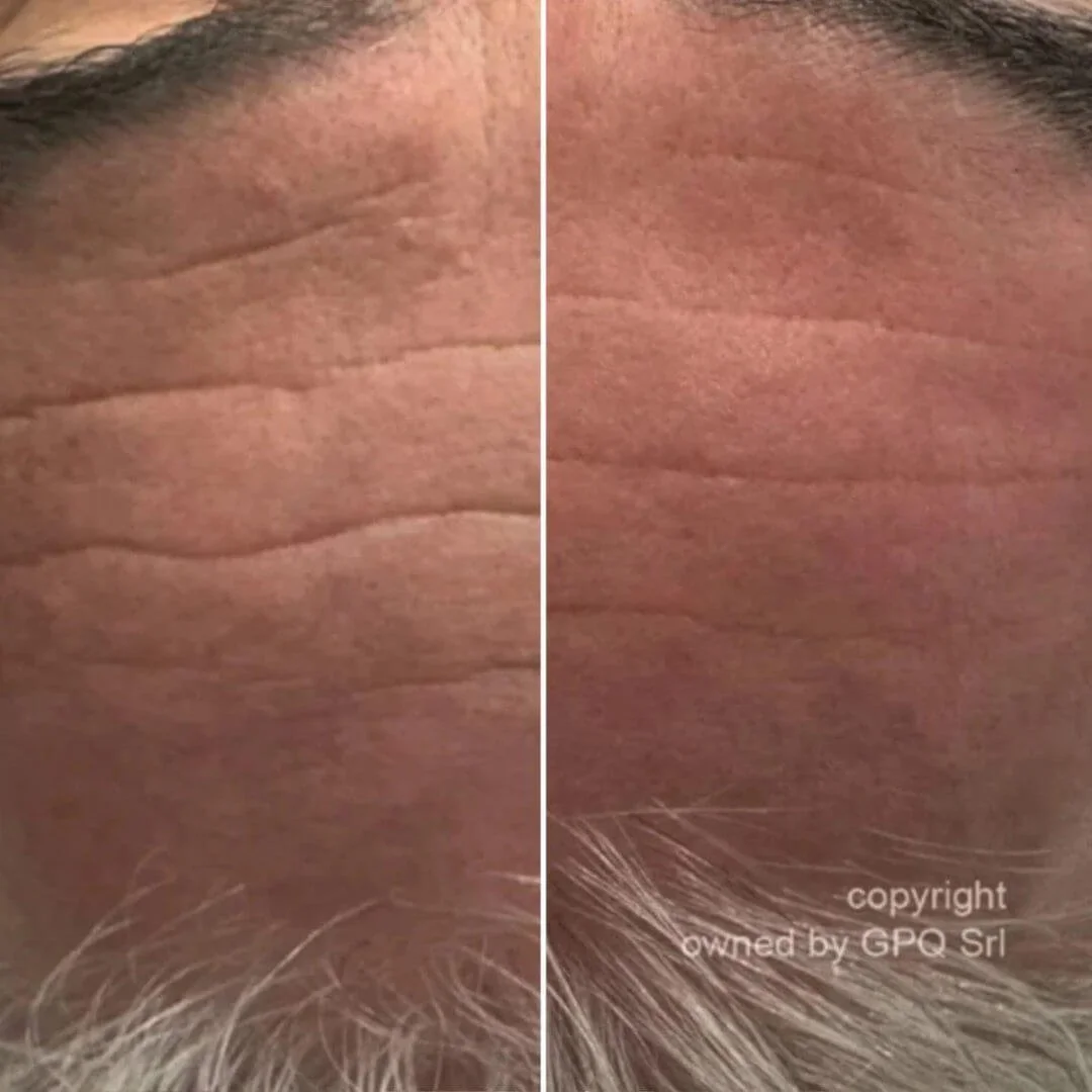 Before and after images demonstrating the appearance of softened forehead lines following PRX Plus biostimulator treatment.