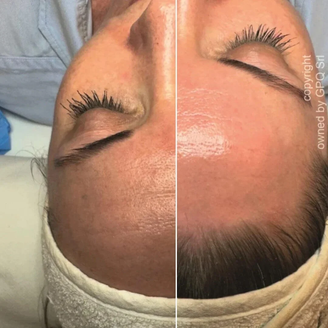 Before and after comparison highlighting a client's smoother, brighter, and more radiant skin after PRX Plus treatment.