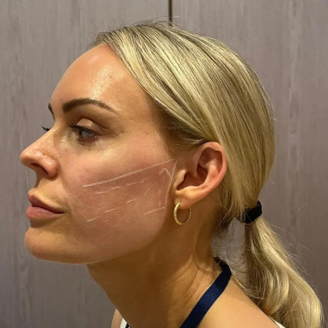 Aesthetics nurse demonstrating facial assessment markings during a professional training session.