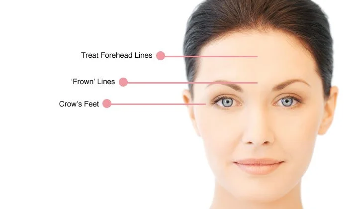 A woman with labels pointing to her forehead and face indicating common facial lines, including "Treat Forehead Lines," "'Frown' Lines," and "Crow's Feet".