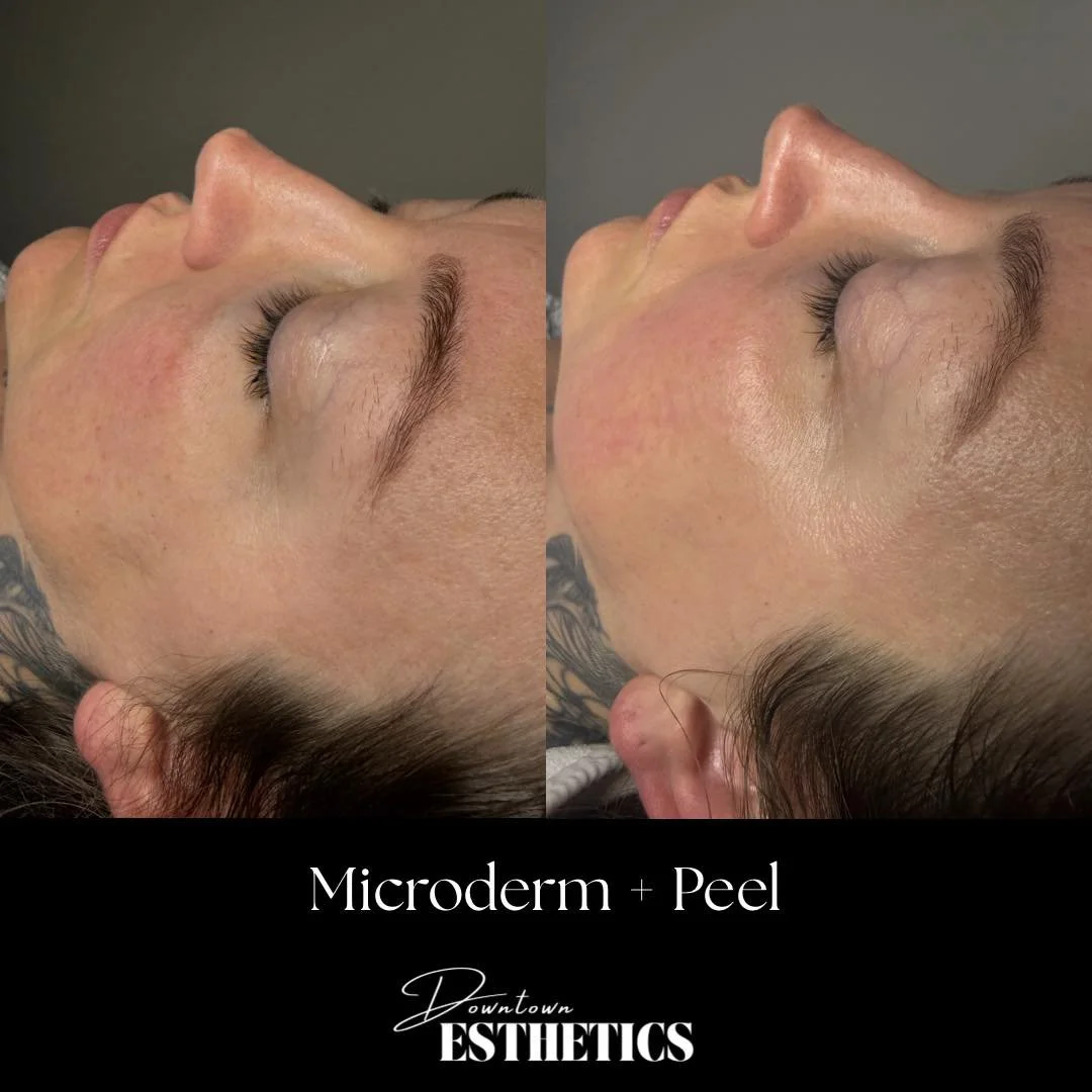 Dull skin doesn&rsquo;t stand a chance. 

Smooth. Clear. Refined. 

The result of our Micro + Peel treatment, one of our go-to combinations for instantly smoother, brighter skin.

Full service list coming soon ✨

provider: Jaedyn Esthetics 

#facials