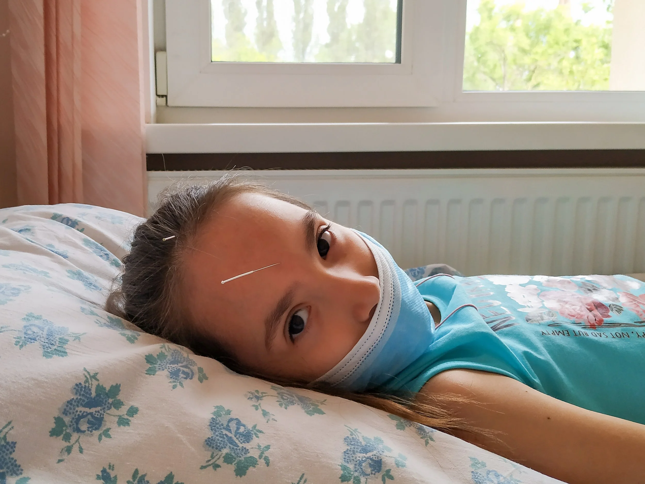 Young girl lying on a bed with acupuncture needles in her forehead and head, wearing a face mask during a pediatric acupuncture session.