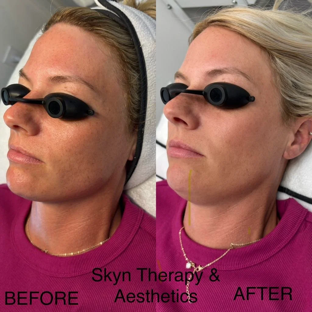 Dermaplane + JoliPeel