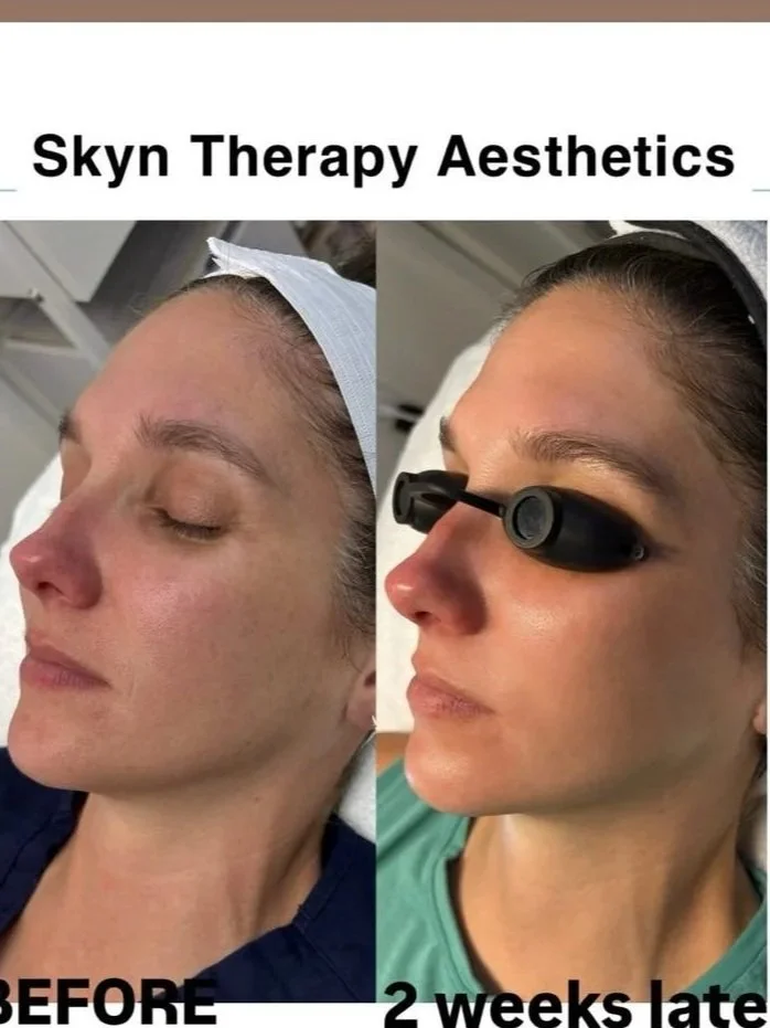 PRX Derm Perfexion + Microneedling