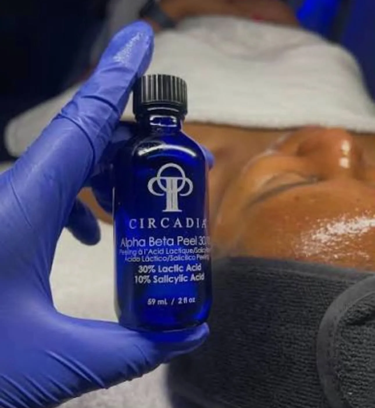 Lactic Acid Chemical Peel