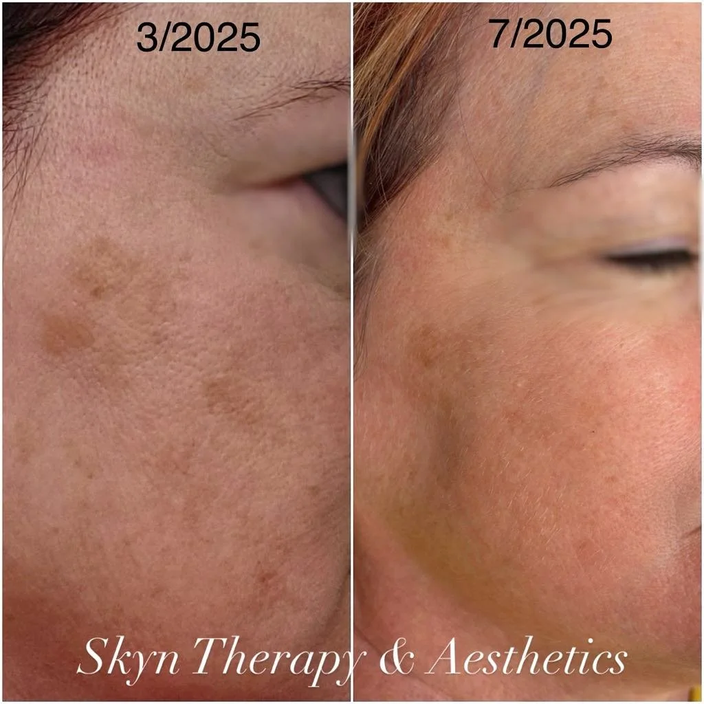 Microneedling / after 3 treatments/ 1 month apart