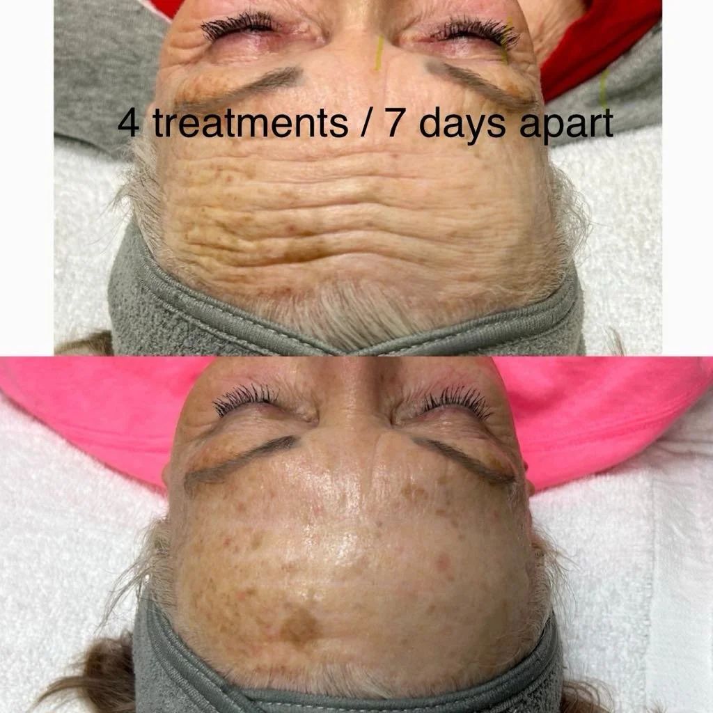 PRX Derm Perfexion / 4 treatments /7 days apart