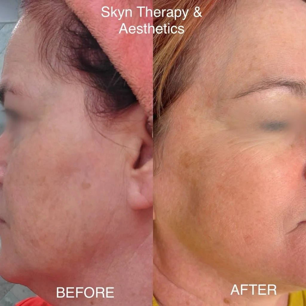 Microneedling /3 treatments/1 month apart