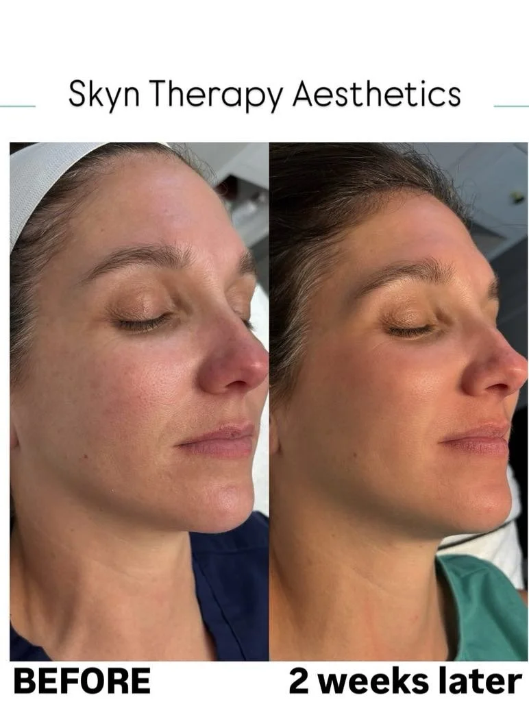 Microneedling + PRX 1 treatment