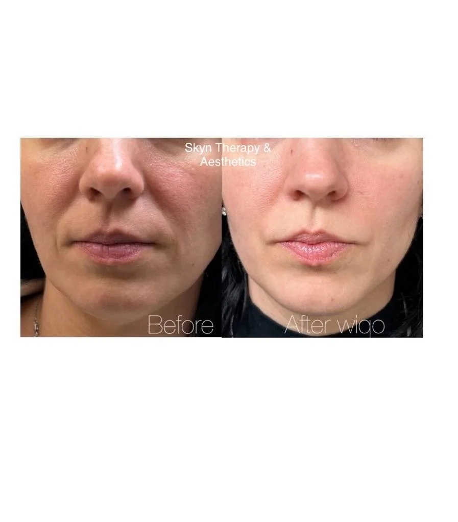 PRX / 4 treatments/ 1 month apart