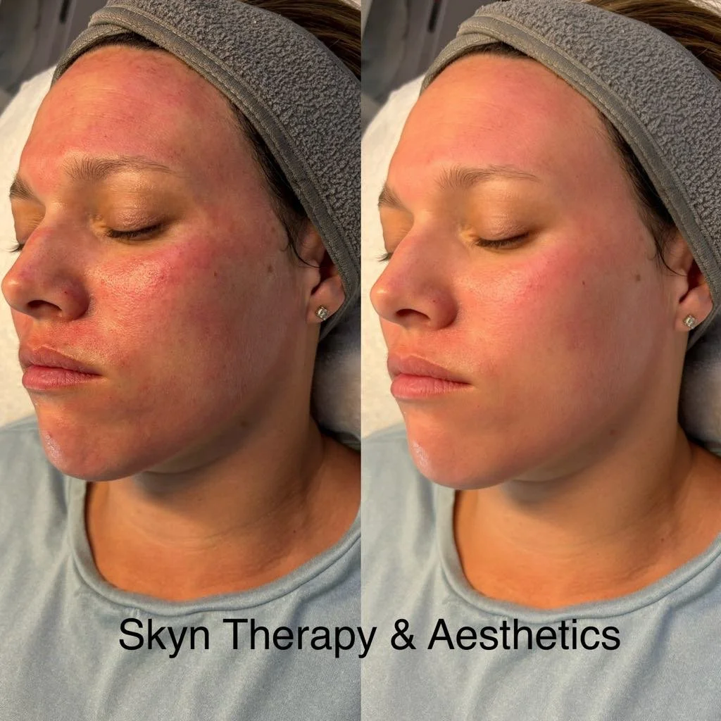 Microneedling + Restorative HA+ Masque