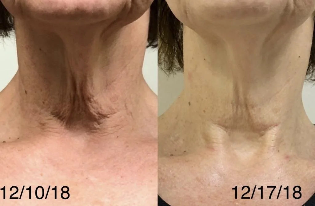 PRX 1 treatment
