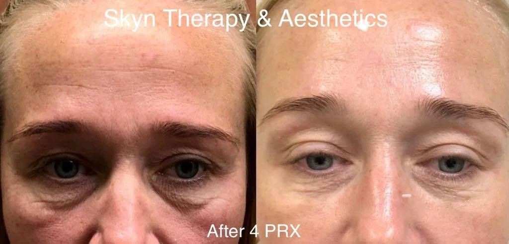 PRX after 4 treatments / 7 days apart