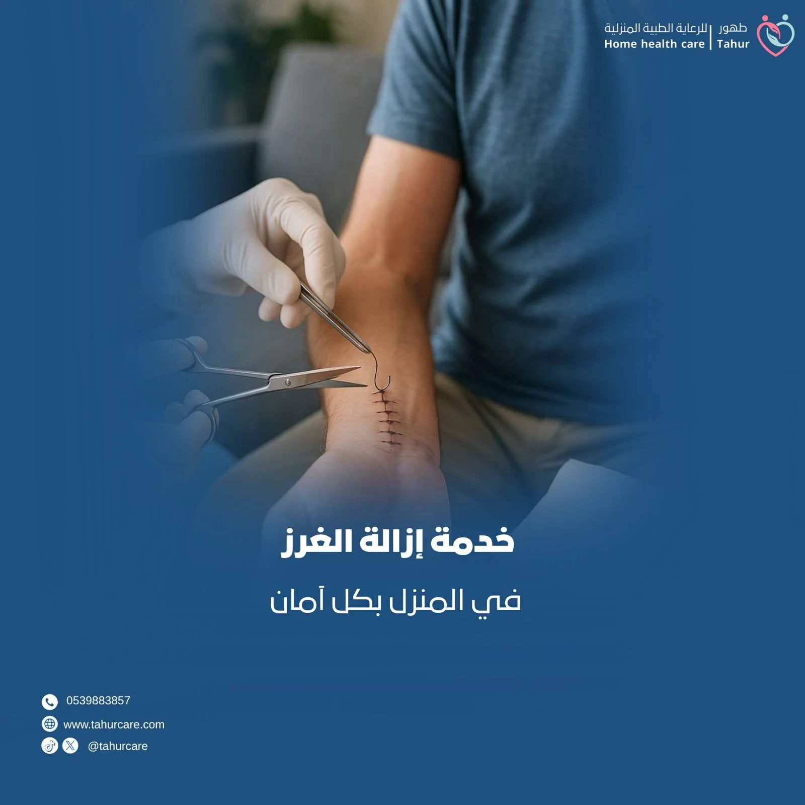 إزالة الغرز