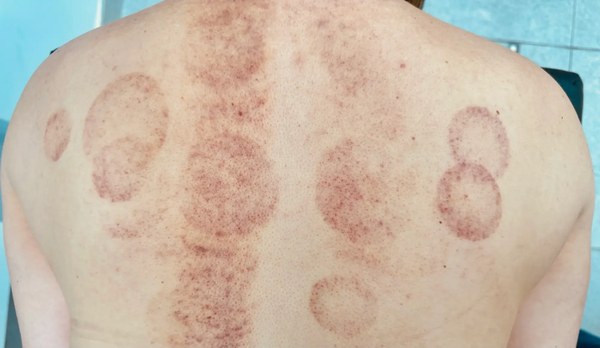 Cupping marks on a patient's back at NRQi Studio in Winchmore Hill, North London N21.